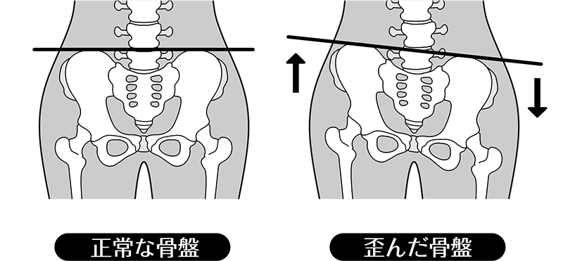 骨盤矯正