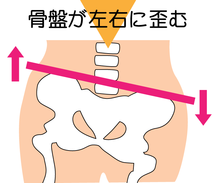 骨盤が左右に歪む